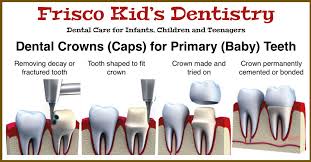 But in some cases, tooth crowns can lead to increased sensitivity. Dental Crowns Caps Primary Baby Teeth Frisco Kid S Dentistry