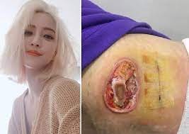 한예슬씨가 인스타그램에 20일 공개한 지방종 제거수술 사진에 대한 기사입니다.2주전 왼쪽 등에 생긴 것으로 추정하는데 사진에서 보시다시피 상처가 제대로 아물지 않아 큰 흉터가 생길 것으로. í•œì˜ˆìŠ¬ ì˜ë£Œì‚¬ê³  ì§€ë°©ì¢… ì œê±°ìˆ˜ìˆ  ë¶€ìž'ìš© ì‹¬ê° ì´ì§€í˜„ êµìˆ˜ ê³¼ì‹¤ ì¸ì •