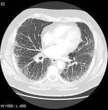 Rheumatoid Interstitial Lung Disease Uip Pattern Radiology Case Radiopaedia Org