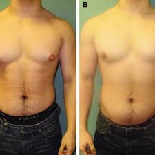 Pdf Anatomy Of The Gynecomastia Tissue And Its Clinical Significance
