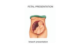 Image result for Breech Presentation