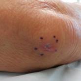 White piedrawhite piedra is a relatively rare fungal infection of the hair shaft which is the keratinized portion of a hair that extends from ahair follicle. Long Term Pubic Dermatitis Diagnosed As White Piedra Mdedge Dermatology