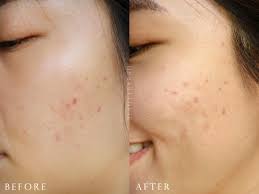 Kimberly is a true professional. Novu Aesthetics P Phyto Laser Ion Infusion Review Beautybyrah