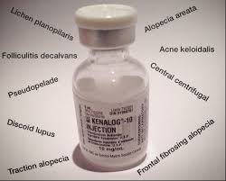 Read about cortisone injection treatment for inflammation, allergic reaction, sciatica, and arthritis. Steroid Injections Dr Donovan S Hair Loss Articles 2011 2021 Donovan Hair Clinic