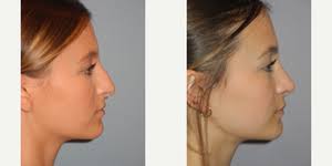 Top Asian Rhinoplasty Doctors in Paoli, PA