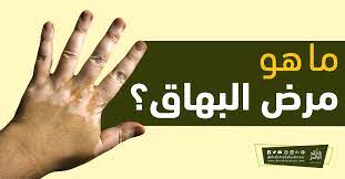 تعرف على مدة انتشار البهاق في الجسم ومكان انتشارها