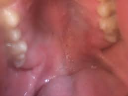 Cancer patients of reddit, what symptoms brought you to the doctor in the first place, leading to your diagnosis? Hpv Throat Cancer Reddit