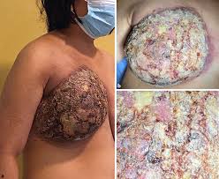Image result for Inflammatory breast cancer
