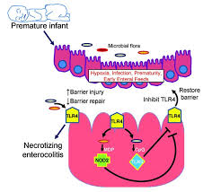 Image result for Necrotizing Enterocolitis