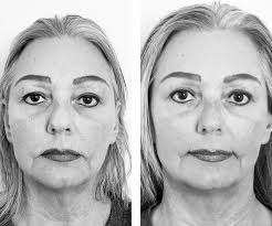 Upper Blepharoplasty 6 weeks. This wonderful patient is healing remarkably  fast! Before her surgery she would strain at a computer raising her lids  and brow to see with almost daily headaches. We