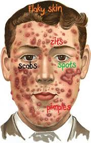 Fun Facts About Pimples Scabs Dandruff And Other Skin Issues Natural Acne Remedies Pimples Nodular Acne