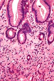 The cancer has not spread to lymph nodes or other tissues or organs, but has grown through the main muscle layer of the stomach wall into the subserosa (the thin layer between the main muscle layer of the stomach and the outside membrane of the stomach, called the serosa). Signet Ring Cell Carcinoma Wikipedia