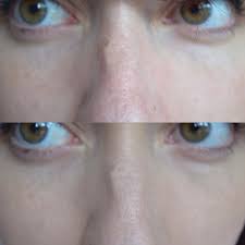 Fond de teint super mat zéro brillance. Attention Aux Faux Avant Apres Du Fond De Teint Younique
