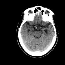 Lesions similar to cytotoxic edema, and lesions similar to vasogenic edema. Herpes Simplex Virus Hsv Encephalitis Radiology Case Radiopaedia Org