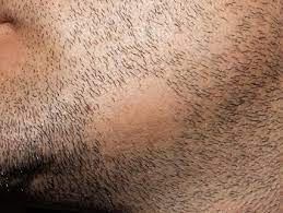 They're the easiest and least expensive way for a full beard. Why Is The Bald Spot In My Beard Growing Back White