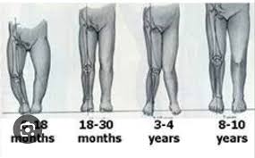 Image result for Genu Varum