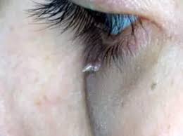 Image result for verrucae filiformes