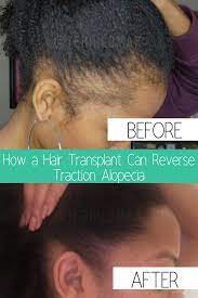 In A World Of Perfected Brows On Instagram And Baby Hairs That Look Like Works Of Art There Is One Con Traction Alopecia Hair Transplant Women Hair Transplant
