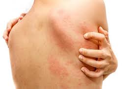 Image result for dermatitis contacta