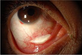 Image result for Scleritis