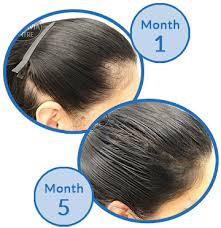 After 6 months your hair starts growing again naturally. Abbey Clancy Says Pregnancy Hair Loss Knocked Her Confidence