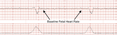 A Guide To Electronic Fetal Monitoring Cardiotocogram Stepwards