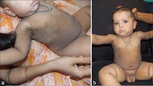Image result for Ichthyosis