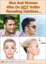 Receding Hairline Receding Temples Learn How And Why Grow Hair Back Hairline Hair Growth Faster