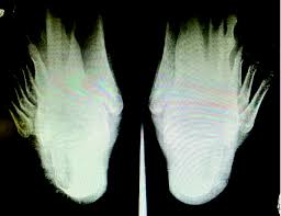 Image result for Calcaneal Apophysitis