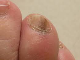 15 avril 2016 à 22 h 33 min. Tache Sur Un Ongle Acne Psoriasis Et Problemes De Peau Forum Sante Doctissimo