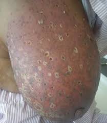 Image result for zoster under breasts