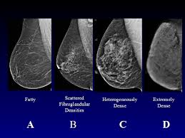 It said 1 million women. What Should You Know About Breast Density Breast Cancer Awareness Month Women S Health Research Institute