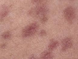 The second most common most commonly, you will have a rash of red or pink spots on your body. Syphilis Images Dermnet Nz