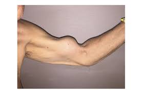 Here S Why A Man S Arm Looks Like Popeye S Man Short News Cartoon Characters Names