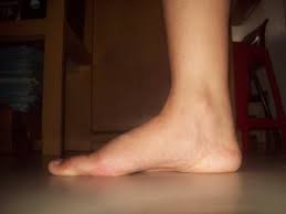 Plantar fasciitis adalah peradangan pada jaringan penghubung antar tulang (ligamen) di telapak kaki, tepatnya di antara tumit dan lengkungan kaki. Sakit Tumit Asam Urat Atau Bukan Halaman 1 Kompasiana Com