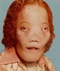 Film: “Kenny” aka “The Kid Brother” c. 1988. Kenny Easterday was born in  1974 in West Aliquippa, Pennsylvania with only half a spine, a rare  condition called Sacral Agenesis. When he was