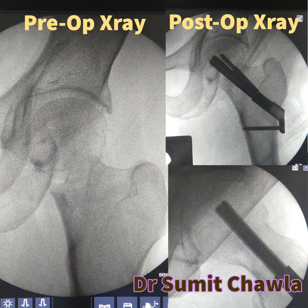Femoral neck system product image