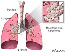 Most of the signs associated with small cell lung cancer (sclc) are not present until the cancer has progressed. Lung Cancer Small Cell Information Mount Sinai New York