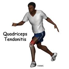 But ask a beginner what quad exercises can build big, powerful quad muscles, and you're usually going to get two answers: Quadriceps Tendonitis Eorthopod Com