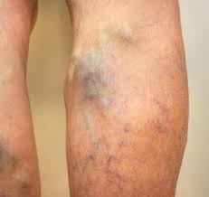 Leg Pain Indicate Heart Problems ...