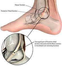 Posterior Tibial Tendon Dysfunction Acquired Flatfoot Orthopedics Library Demo