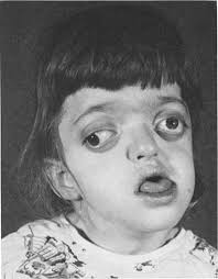 Crouzon's disease (craniofacial dysostosis) Modern diagnosis and treatment