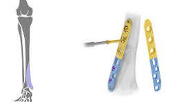 Metaphyseal 3,5 / 4,5mm - Astrolabe