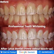Maybe you would like to learn more about one of these? Dentist3 Teeth Whitening Clinic Malaysia Klinik Pemutihan Gigi Malaysia æ¼‚ç™½ç‰™é½¿ Dentist Malaysia