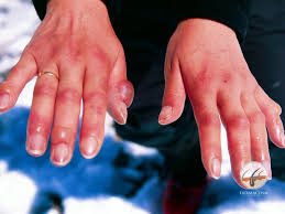 Image result for Chilblains