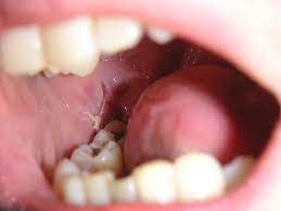 Your wisdom teeth are the only teeth you grow as you enter your late teens or early but, even if one of them is misaligned, such in a position that it overcrowds your mouth, you have to get it removed. Cost To Remove Wisdom Teeth Nz Teethwalls
