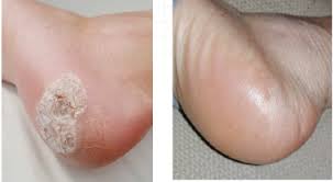 Image result for WART TREATMENT BEFORE AND AFTER PICTURE