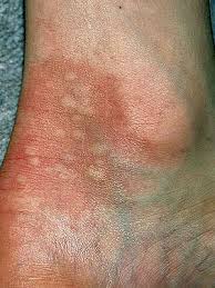 Poison Ivy Poison Oak And Poison Sumac Plants All Look Harmless But Don T Be Fooled Get To Know Various Poi Poison Sumac Plant Poison Sumac Rash Poison Oak