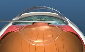 Image result for Cataract Extraction