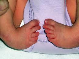 Image result for Clubfoot